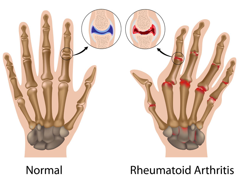 Rheumatoid Arthritis - Naturopathic Approaches